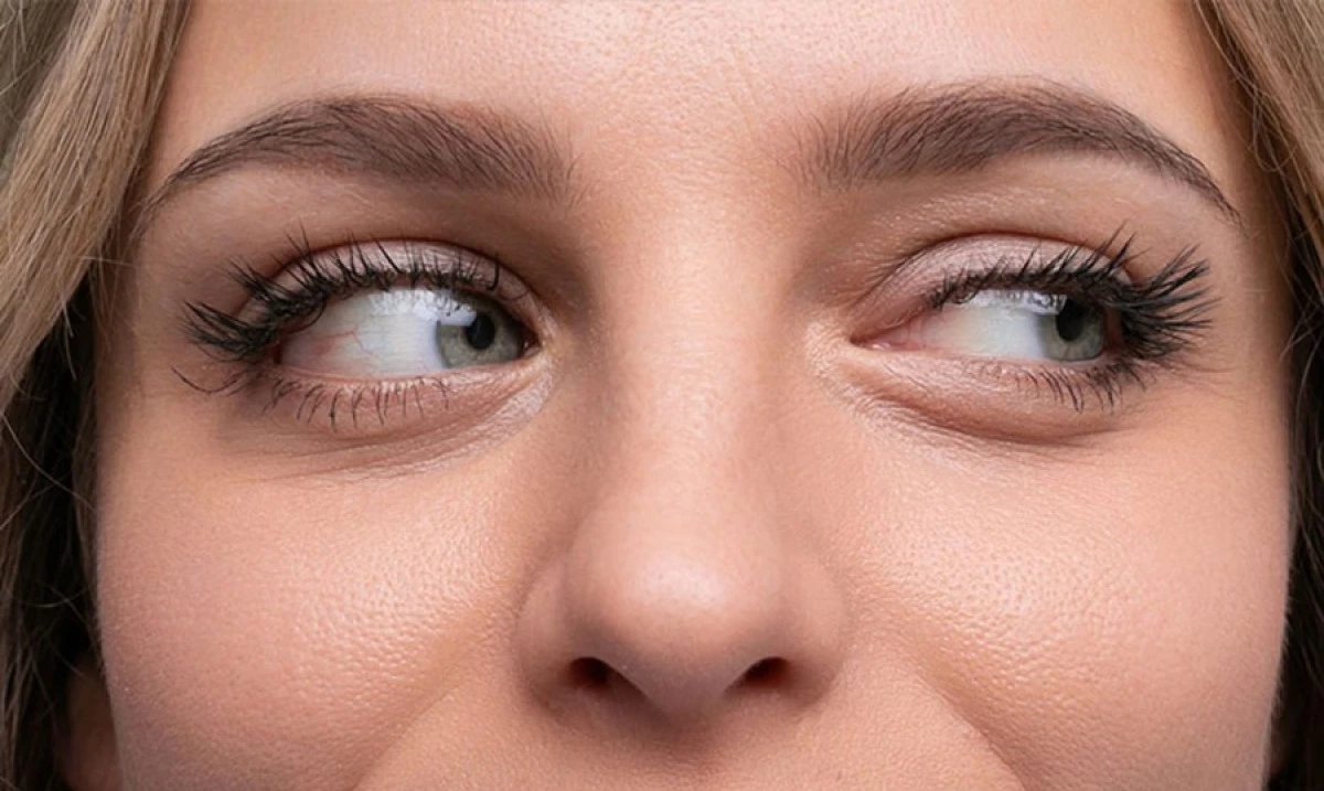 SULANMA VE KAŞINTI VARSA DEMODEX PARAZİTİNE DİKKAT